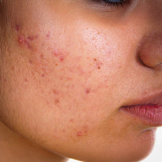 Ayurvedic Pimple Treatment and Acne Care Products