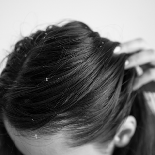 Dandruff