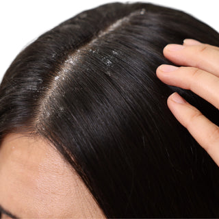 Ayurvedic Anti-Dandruff Products and Scalp Treatment